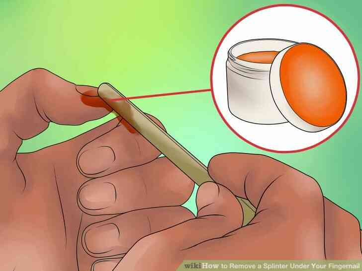 Image intitulée Enlever une Écharde Sous Ton Ongle Étape 8